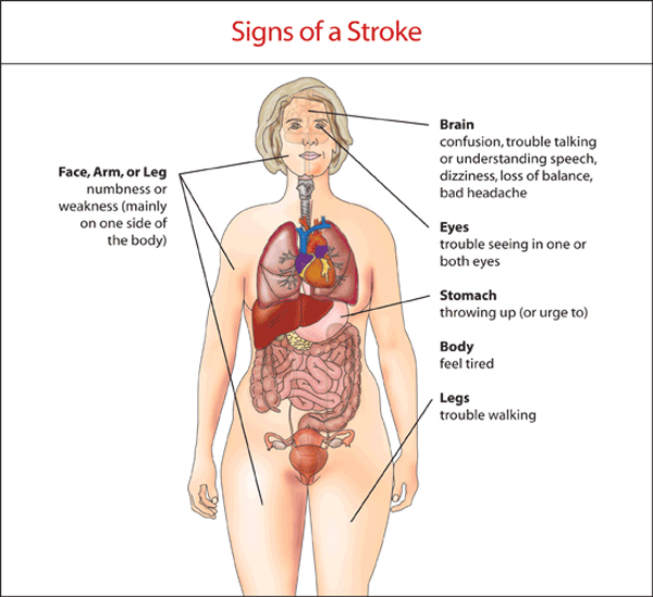 Stroke Indicator How To Know If Someone Is Having A Stroke A Patie